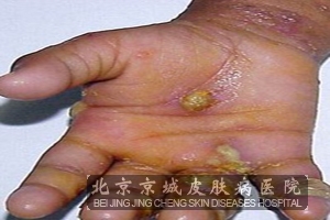 疥疮结节 疥疮结节怎么办 - 资讯 - 铜仁网 - 铜仁