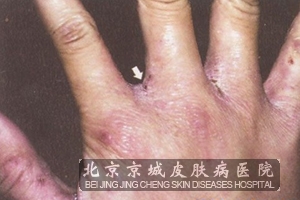 疥疮的初期症状图片