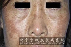 黄褐斑的易感人群有哪些