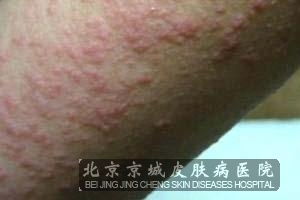 过敏性湿疹外用药治疗方法