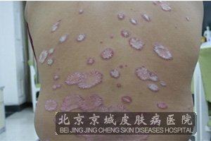 北京中医院皮肤科银屑病如何治才能好