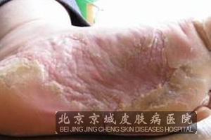 脚底脱皮是怎么回事