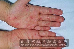 北京治皮肤过敏医院哪家比较好_河北频道_长