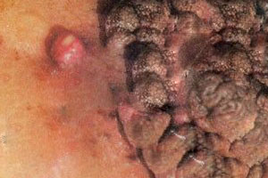 尖锐湿疣是怎样引起的