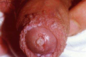 尖锐湿疣的早期症状有哪些