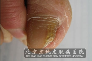 灰指甲有哪些误区