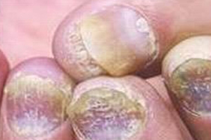 灰指甲的日常预防方法