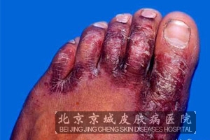 ʪ��֢״��ʲô�ص�