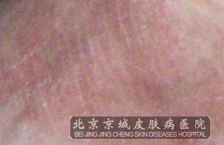 过敏性紫癜的临床症状表现有哪些