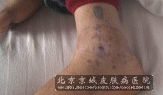 过敏性紫癜的治疗方法有几种