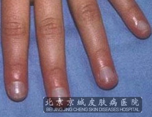 灰指甲的季节性传播