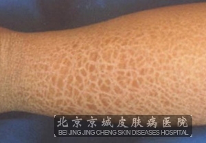 鱼鳞病患者饮食方面该注意什么