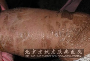 先天性鱼鳞病主要有哪几种