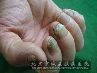 灰指甲容易治吗