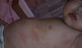 怎样护理小儿荨麻疹