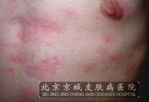 引发荨麻疹的原因有哪些