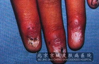 灰指甲对患者的常见危害