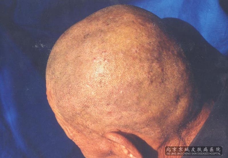 脂溢性皮炎有哪些饮食注意