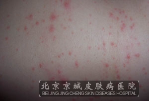 荨麻疹在生活中要注意什么