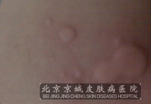 荨麻疹的早期症状有哪些