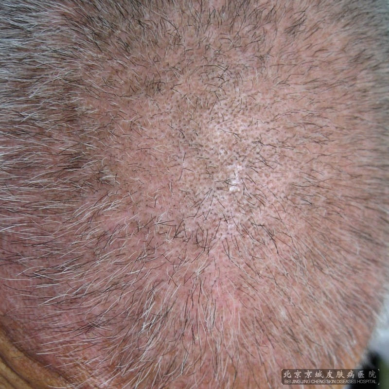 患有脂溢性皮炎的症状有什么