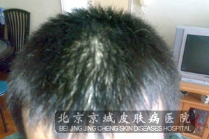 脂溢性皮炎的护理是什么