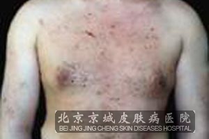 脂溢性皮炎的病因病理是什么