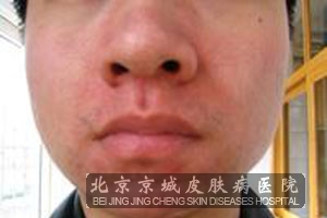 脸部脂溢性皮炎的护理