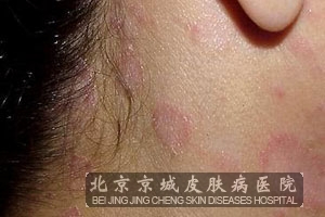 脂溢性皮炎的预防和护理有哪些