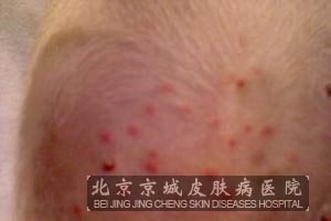 得脂溢性皮炎的临床表现有哪些