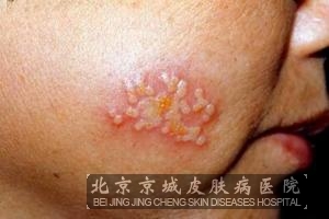 单纯疱疹有什么症状