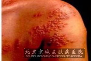 扁平疣初期图片