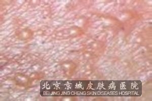 小孩出水痘的症状