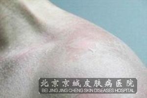 日光性皮炎能治除根吗