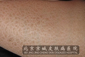 鱼鳞病的治疗方法