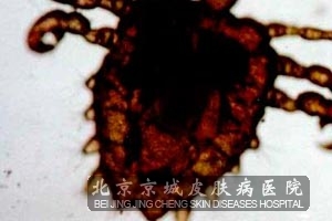 阴虱病症状表现