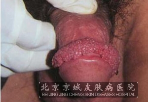 尖锐湿疣的治疗误区有哪些
