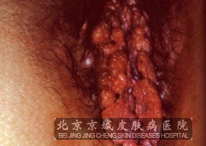 尖锐湿疣复发的因素都有哪些