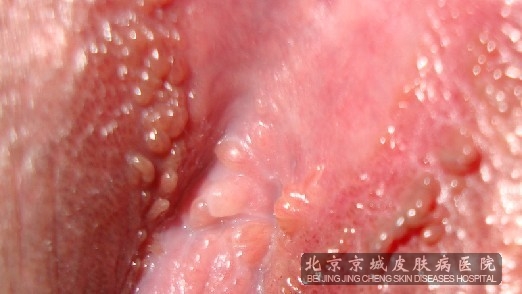 患上尖锐湿疣有哪些危害