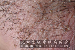 阴虱病的症状都有哪些