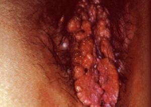 尖锐湿疣的治疗方法