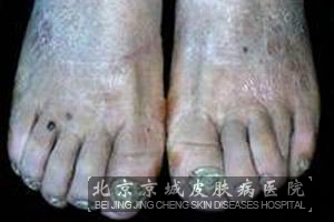 灰指甲的症状都有什么