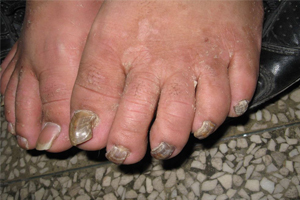 灰指甲的治疗方法推荐