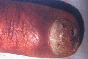 预防灰指甲的要点有哪些