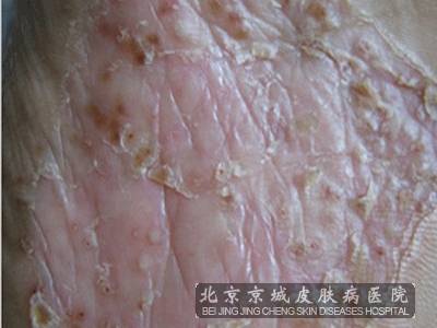 儿童银屑病早期图片是什么