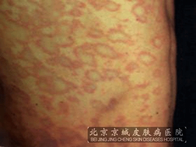 玫瑰糠疹怎么治疗