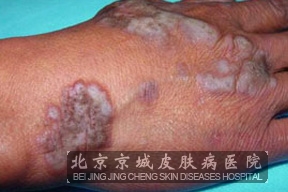 口腔扁平苔藓的治疗