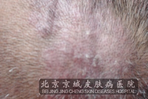 脂溢性皮炎的家庭治疗措施