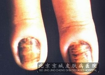 什么会引起得灰指甲