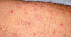 导致脂溢性皮炎加重的原因